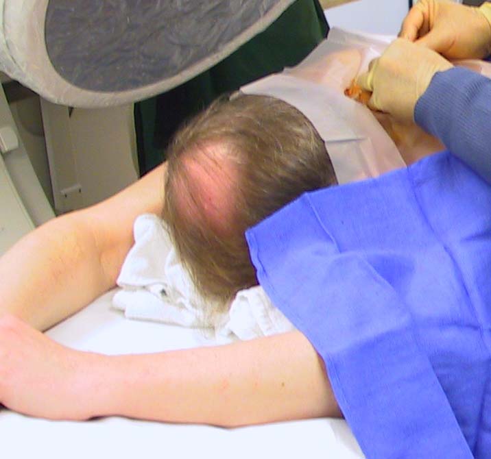Fig 4: Cervical epidural injection patient position. Fig 4: Cervical epidural injection patient position.